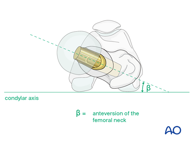 Anteversion of the prosthesis corresponding the anatomical anteversion of the femoral head