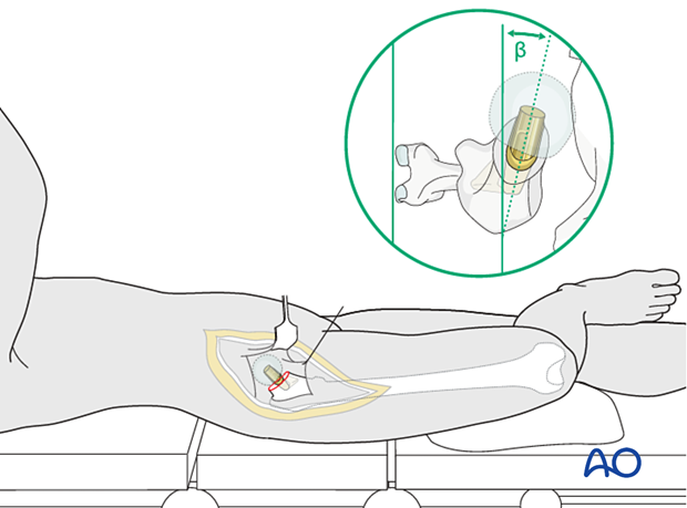 Correct prosthesis anteversion with the patient supine (anterior or anterolateral approach)