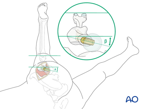 Correct prosthesis anteversion, using the posterior approach with the patient in lateral decubitus position