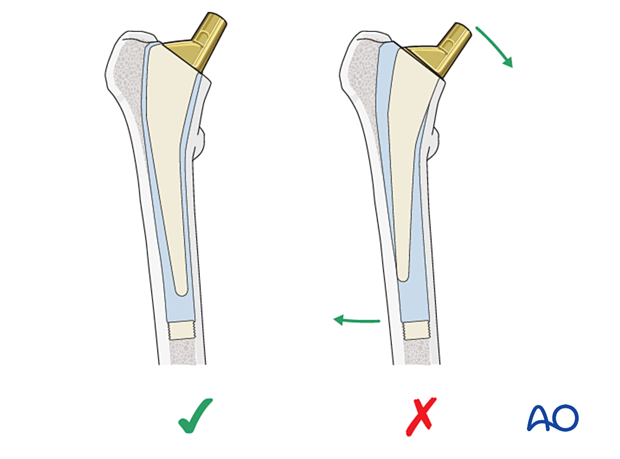 Correct seating (neutral alignment) of the hip prosthesis stem and varus alignment leading to excessive loading stresses