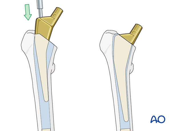 STEM: Press-Fit — Hip & Knee Book