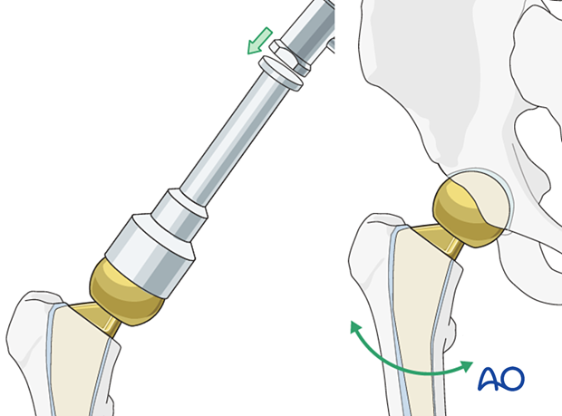 Attachment of definitive femoral head component to the stem of the hemiprosthesis and reduction of the hip