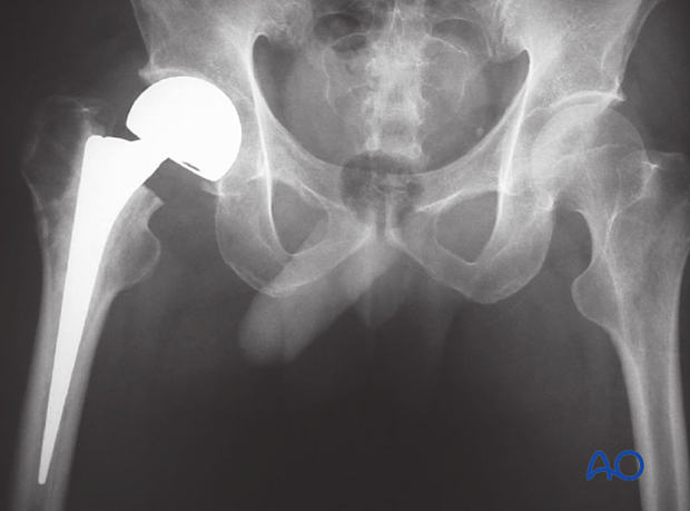 AP x-ray of the hip with hemiprosthesis of the proximal femur