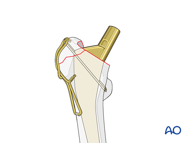 Hemiprosthesis and tension band fixation of the greater trochanter 
