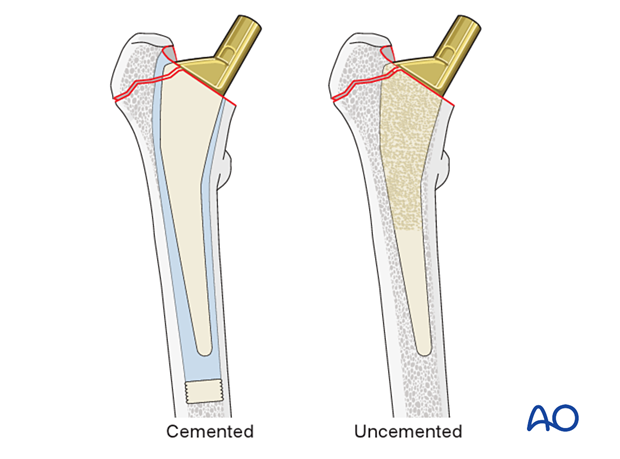 Cemented and uncemented stem for hip prosthesis