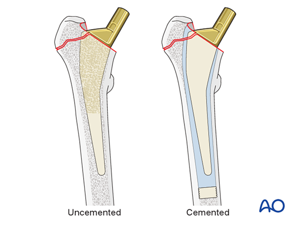 Uncemented and cemented stem for hip prosthesis
