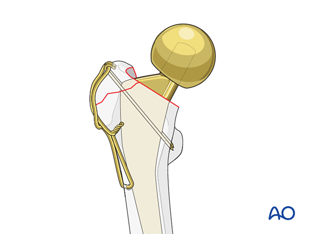 Tension band fixation of the greater trochanter and hip prosthesis