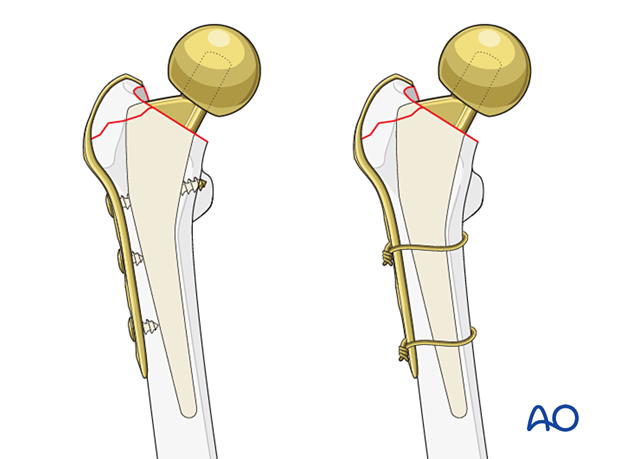 Hook plate fixation of the greater trochanter and hip prosthesis