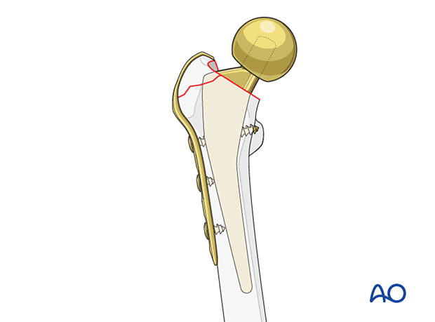 Hemiprosthesis and hook plate fixation of the greater trochanter