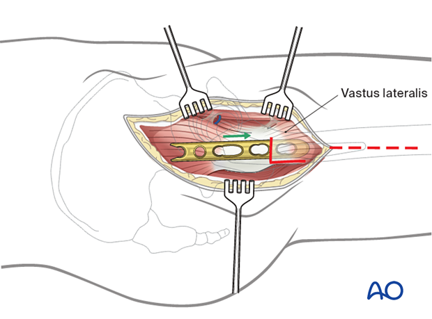 Vastus lateralis origin release or split for hook plate application