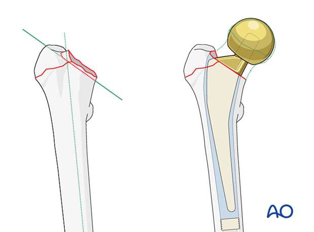 Osteotomy of the femoral neck for stem insertion