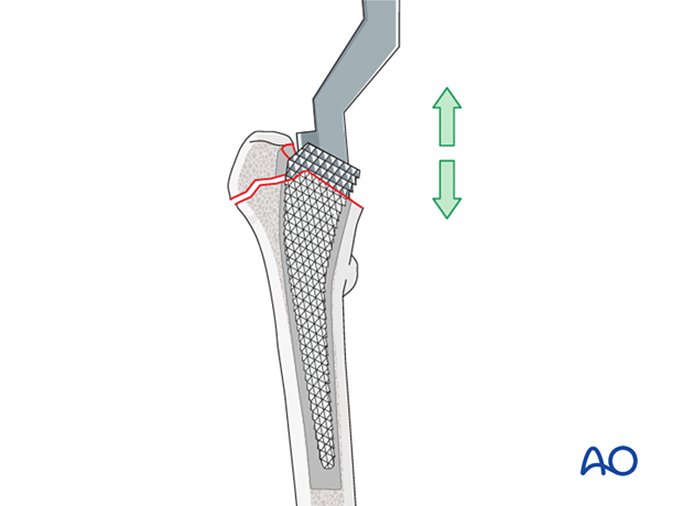 Broaching the medullary canal of the femur for arthroplasty of the hip