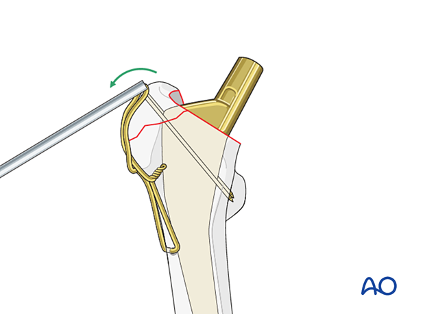 Bending of the K-wire ends for tension band wiring of the greater trochanter