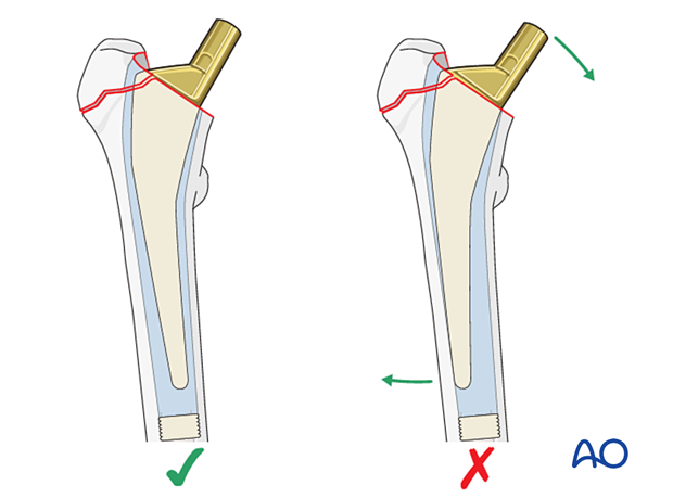 Correct seating (neutral alignment) of the hip prosthesis stem and excessive varus alignment with loading stress