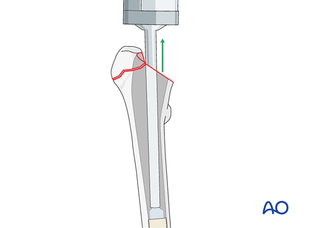 Insertion of cement into the medullary canal of the proximal femur
