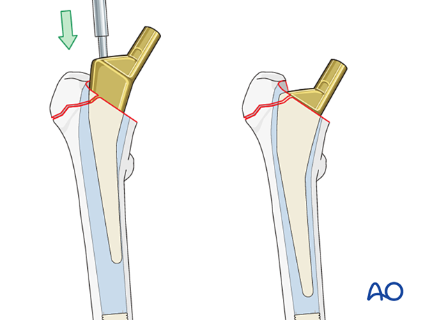 Stem insertion of the hip prosthesis