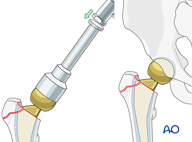 Attachment of definitive femoral head component to the stem of the hemiprosthesis and reduction of the hip