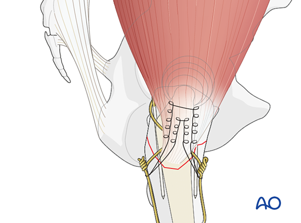 Strong nonbioabsorbable sutures in a Krackow fashion on the top of the gluteus medius tendon to support tension band wiring of the greater trochanter