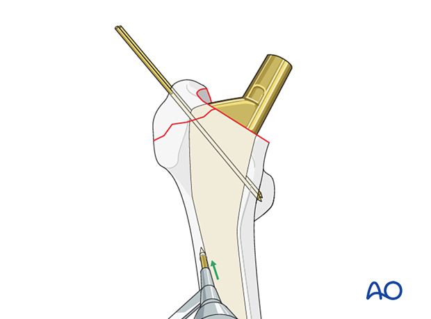 Creating a hole in the lateral cortex of the intact femoral diaphysis for tension band wiring of the greater trochanter
