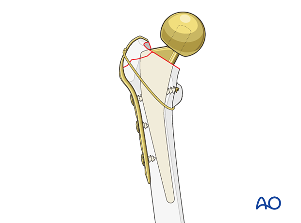 Hemiprosthesis and hook plate fixation of the greater trochanter with cerclage around the trochanters