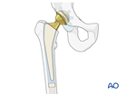 Total hip prosthesis with cemented stem