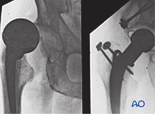 X-rays of a dislocated hemiarthroplasty and salvage by conversion to a hip replacement
