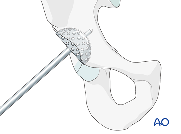 Removal of the acetabular cartilage with a reamer to prepare for total hip arthroplasty