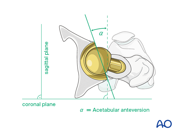 Acetabular anteversion of the inserted cup