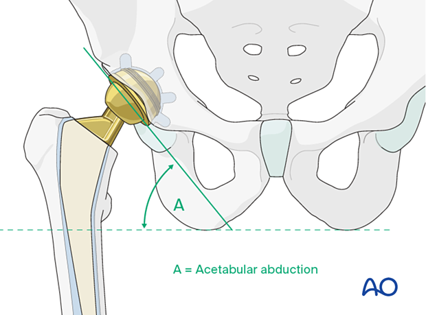 Acetabular abduction of the inserted cup