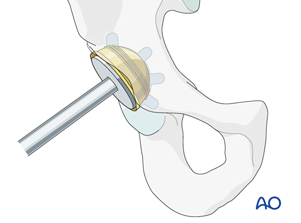 Pressing the acetabular prosthesis in an anatomical position