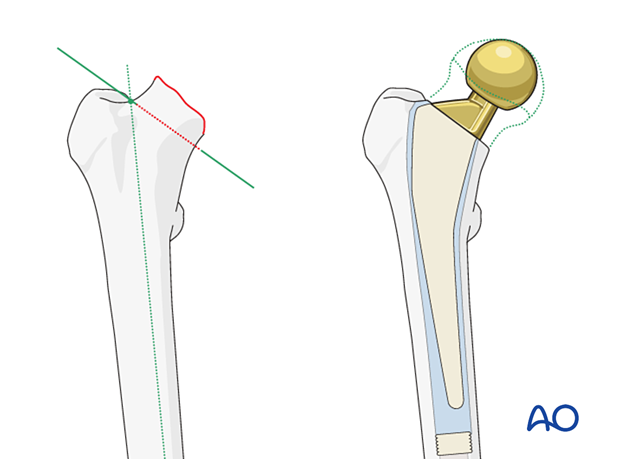 Osteotomy of the femoral neck for stem insertion