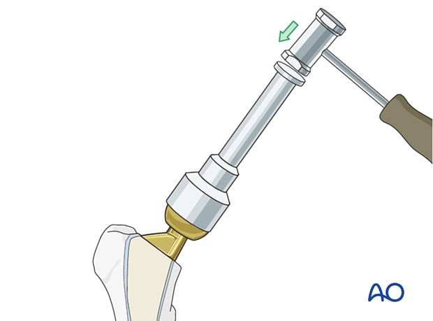 Attachment of definitive femoral head component to the stem of the prosthesis