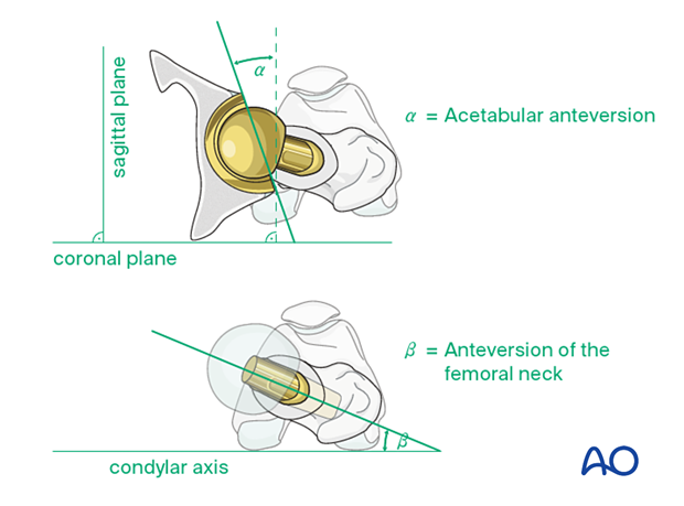 Acetabular anteversion and femoral neck anteversion of the hip prosthesis