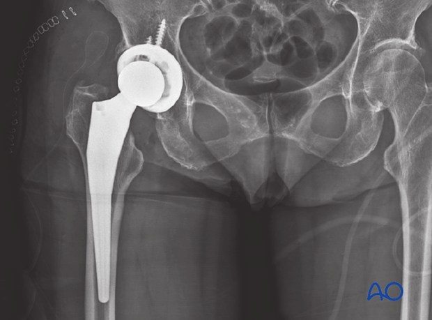 AP x-ray of the hip with total hip prosthesis