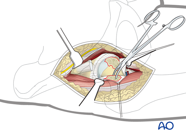 Removal of a large osteochondral fragment with a forceps through an anterior approach