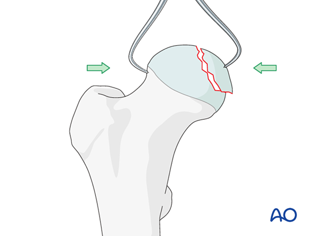 Direct reduction of a femoral head split with a pointed forceps