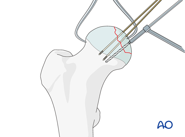 ORIF - Mini-fragment or headless screws for Split fractures ORIF - Mini-fragment or headless screws for Split fractures