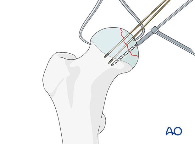 Predrilling for insertion of a headless compression screw to stabilize a femoral head split fracture