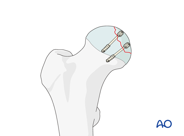 Femoral head split fracture stabilized with headless screws