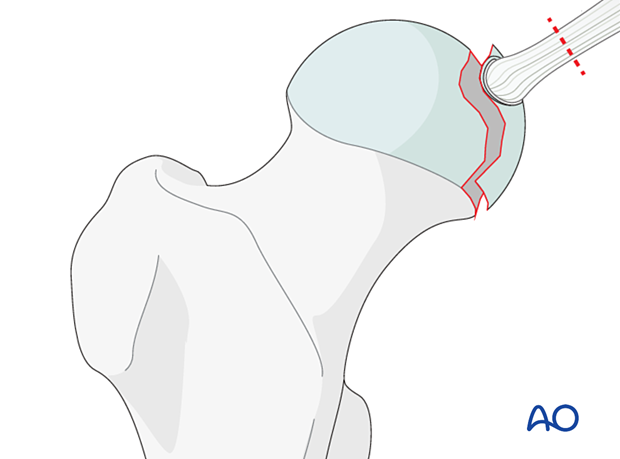 Incision of the ligamentum teres attached to the head fragment in a femoral head split fracture