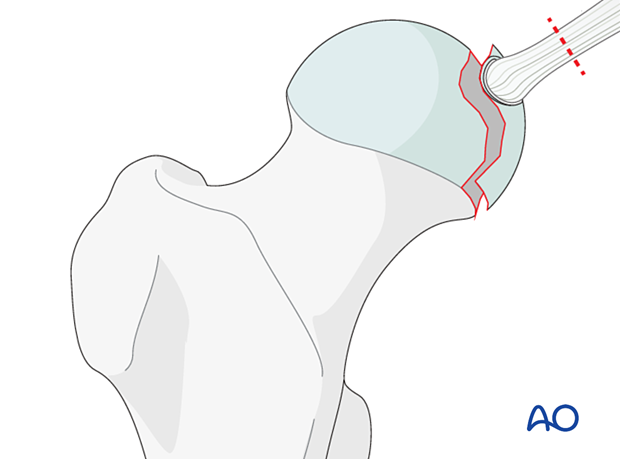 ORIF - Mini-fragment or headless screws for Split fractures ORIF - Mini-fragment or headless screws for Split fractures