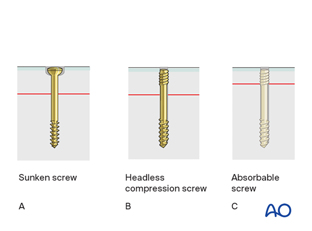 Sunken screw, headless compression screw, and absorbable screw