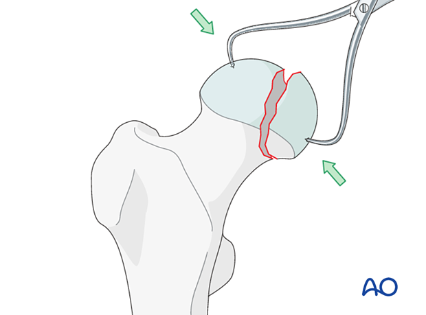 Direct reduction of a femoral head split with a pointed forceps