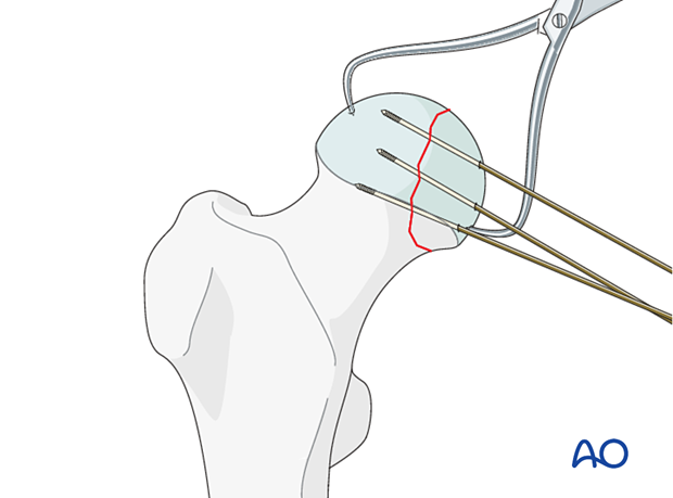 Preliminary stabilization of the reduced femoral head split fracture with K-wires