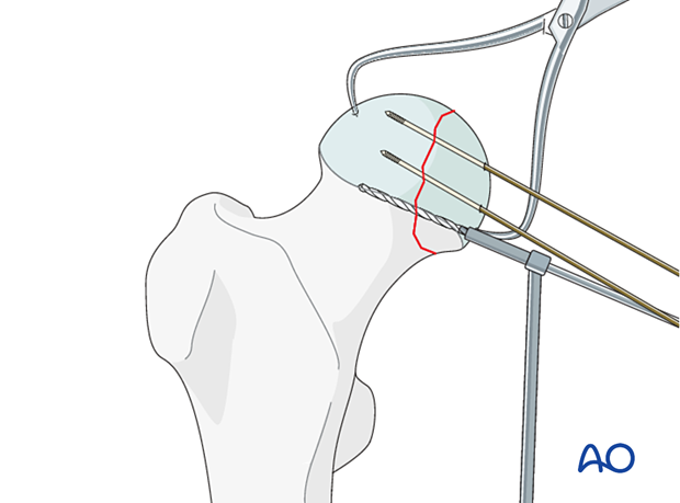 Predrilling for insertion of a headless compression screw to stabilize a femoral head split fracture