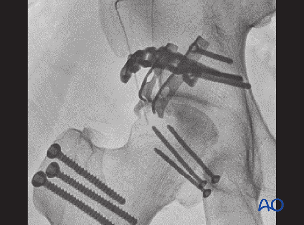 Postoperative x-ray of a femoral head split stabilized with mini-screws, a posterior wall fracture of the acetabulum stabilized with a contoured plate and two hook plates, and screw fixation of the trochanter osteotomy