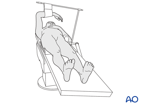 Patient placed supine on a conventional table with a bump under the buttock