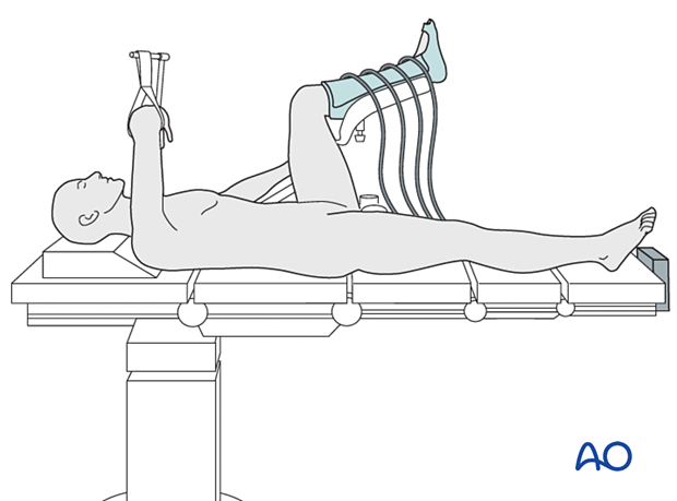 Supine patient position on a radiolucent table with the contralateral leg in a leg holder and VTE pump for surgical treatment of proximal femoral fractures