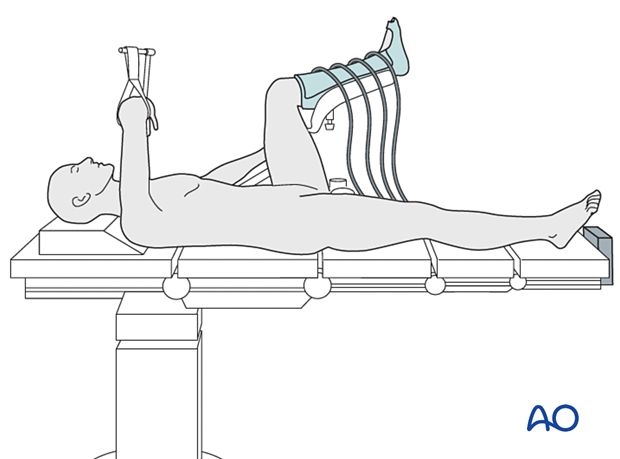 Supine position with manual traction