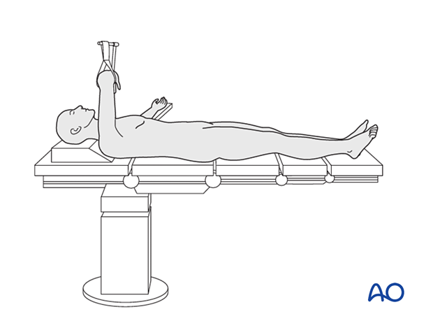 Supine patient position on a radiolucent table for arthroplasty of the hip joint